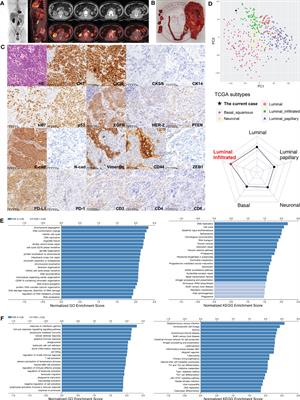 Sustained complete response to first-line immunochemotherapy for highly aggressive TP53/MDM2-mutated upper tract urothelial carcinoma with ERBB2 mutations, luminal immune-infiltrated contexture, and non-mesenchymal state: a case report and literature review